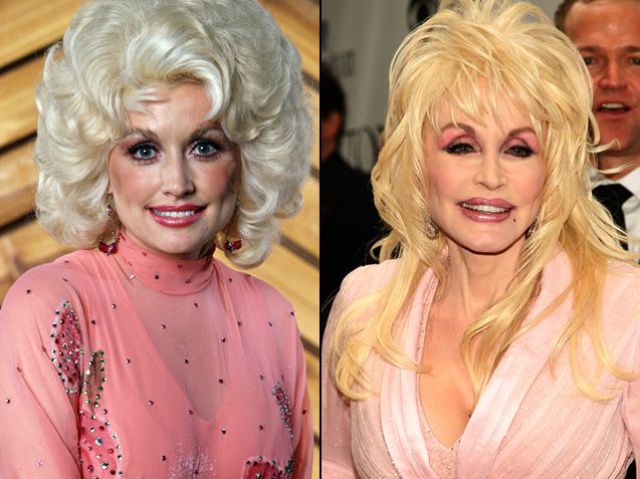 Dolly Parton’s Plastic Surgery