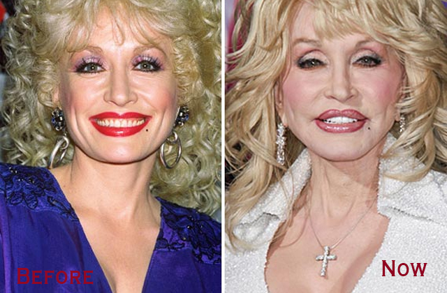 Dolly Parton’s Plastic Surgery