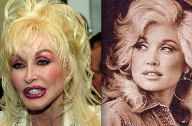 Dolly Parton’s Plastic Surgery