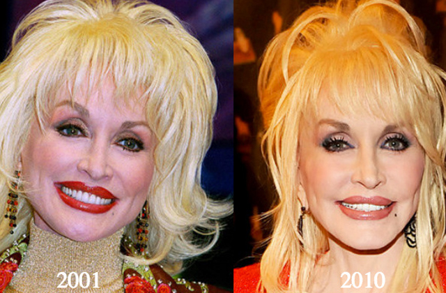 Dolly Parton’s Plastic Surgery