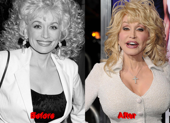 Dolly Parton’s Plastic Surgery