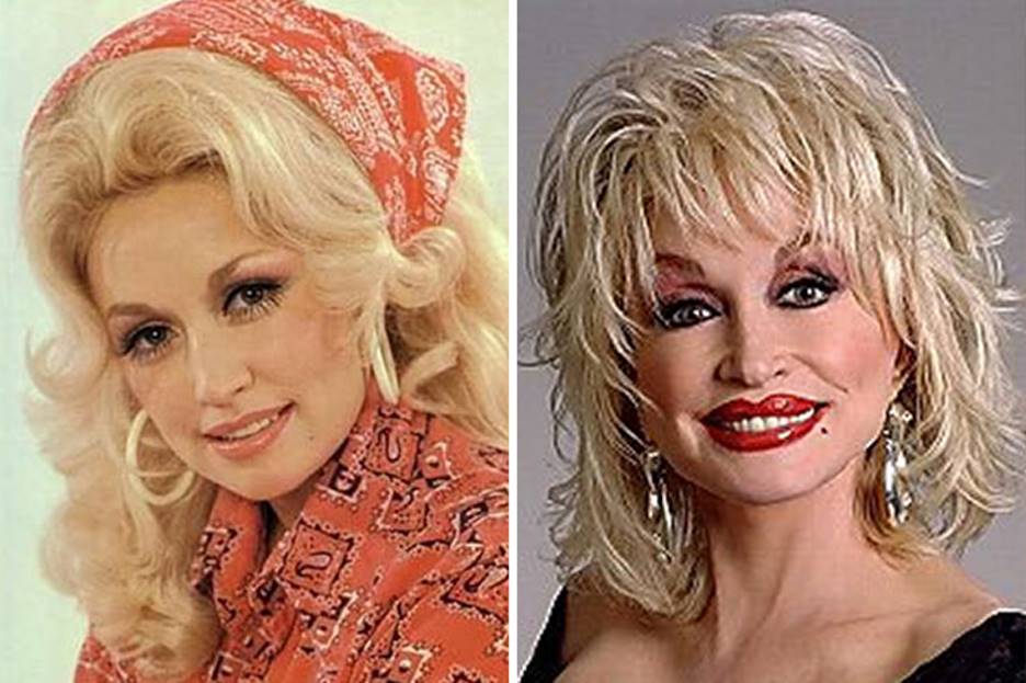 Dolly Parton’s Plastic Surgery