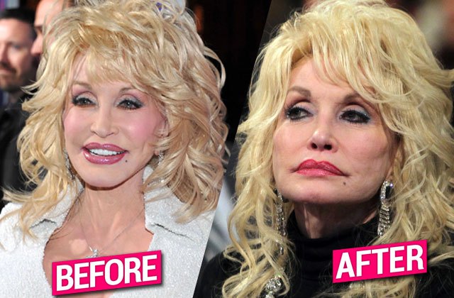 Dolly Parton’s Plastic Surgery